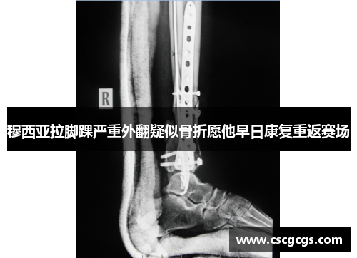 穆西亚拉脚踝严重外翻疑似骨折愿他早日康复重返赛场